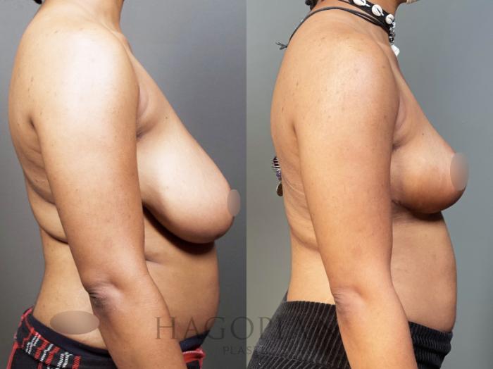 Before & After Breast Reduction Case 8 Right Side View in Atlanta, GA