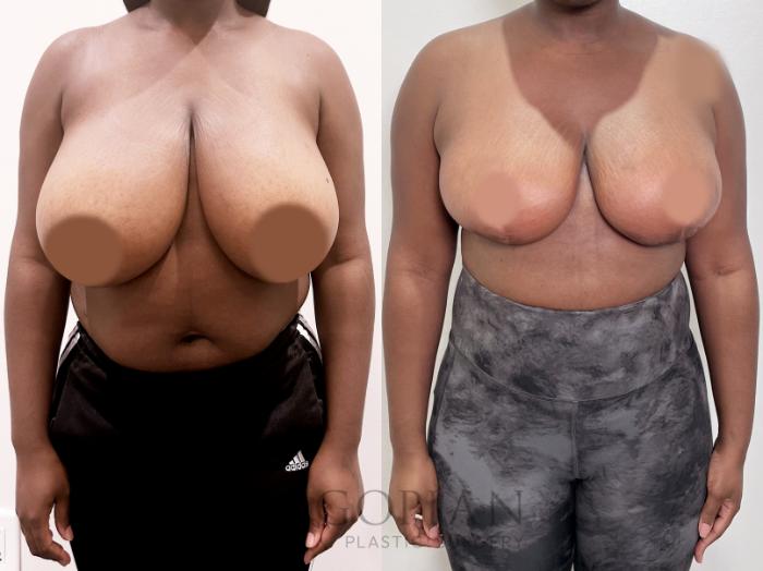 Before & After Breast Reduction Case 86 Front View in Atlanta, GA