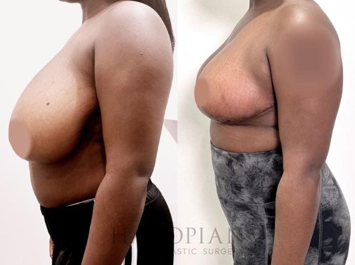 Before & After Breast Reduction Case 86 Left Side View in Atlanta, GA