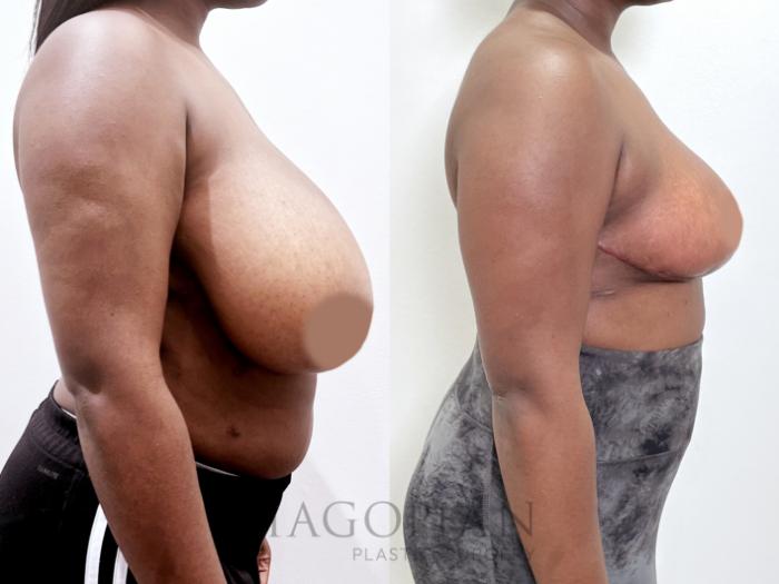 Before & After Breast Reduction Case 86 Right Side View in Atlanta, GA