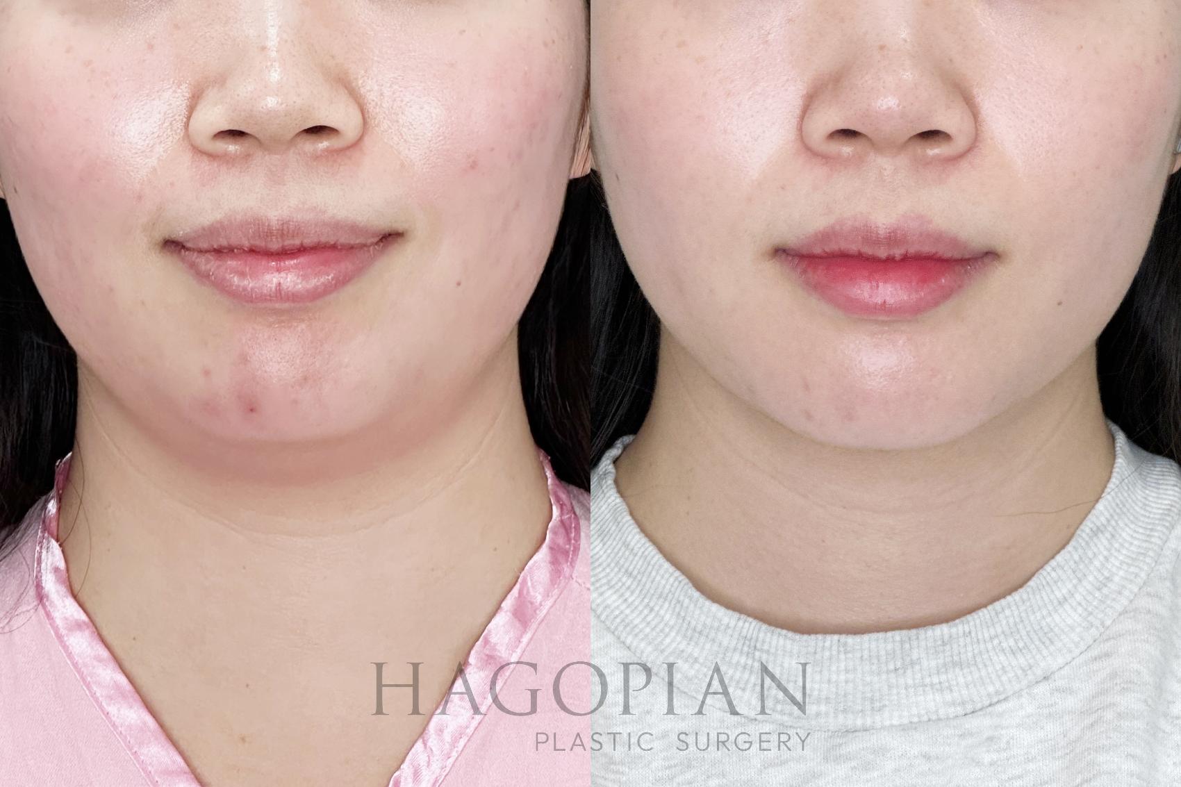 Before & After Chin Liposuction Case 101 Front View in Atlanta, GA