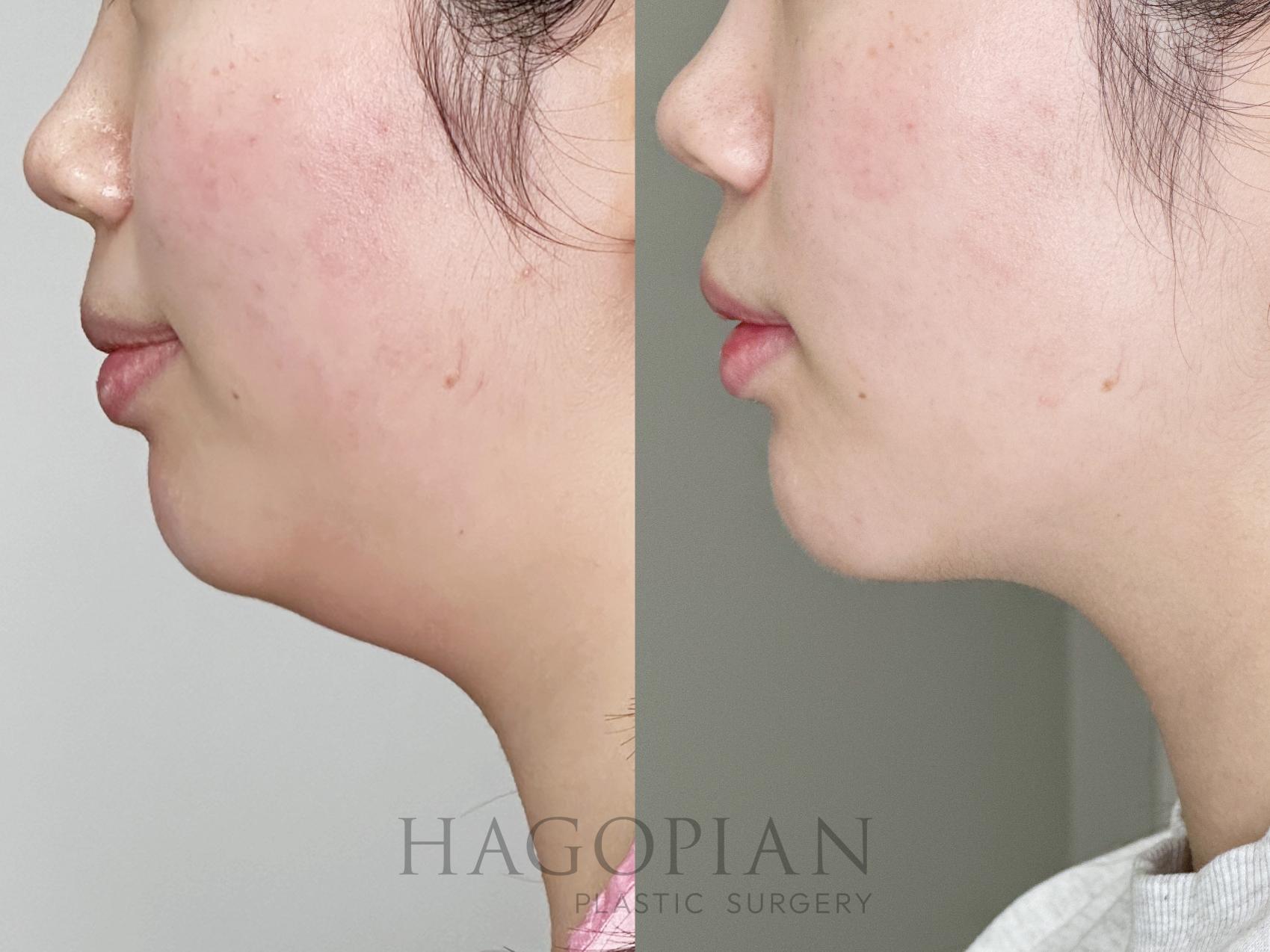 Before & After Chin Liposuction Case 101 Left Side View in Atlanta, GA