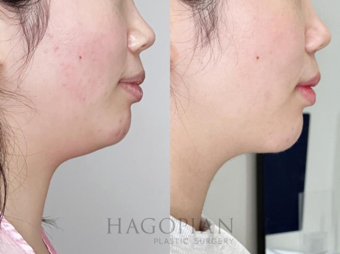 Before & After Chin Liposuction Case 101 Right Side View in Atlanta, GA