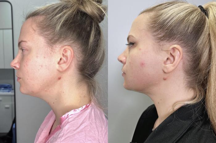 Before & After Chin Liposuction Case 137 Left Side View in Atlanta, GA