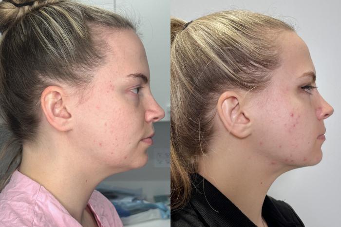 Before & After Chin Liposuction Case 137 Right Side View in Atlanta, GA