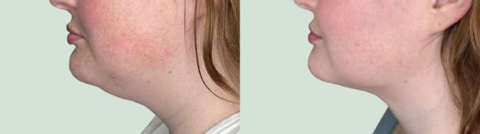 Before & After Chin Liposuction Case 146 Left Side View in Atlanta, GA