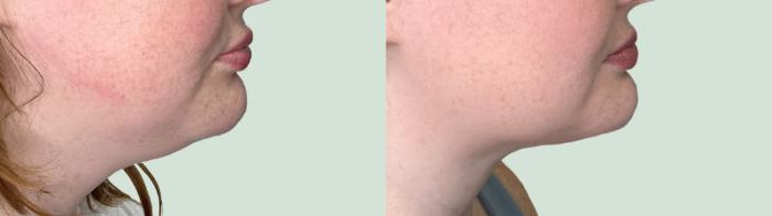 Before & After Chin Liposuction Case 146 Right Side View in Atlanta, GA