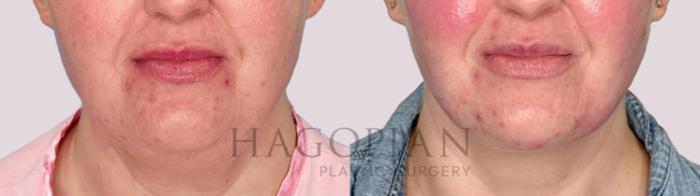 Before & After Chin Liposuction Case 164 Front View in Atlanta, GA