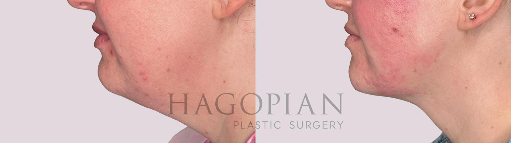 Before & After Chin Liposuction Case 164 Left Side View in Atlanta, GA