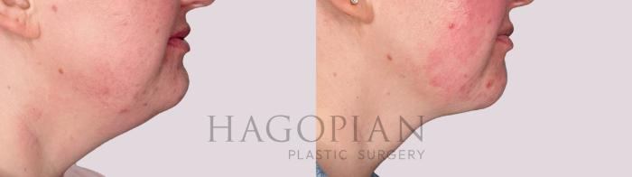 Before & After Chin Liposuction Case 164 Right Side View in Atlanta, GA