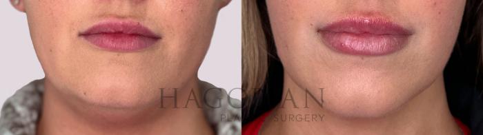 Before & After Chin Liposuction Case 167 Front View in Atlanta, GA