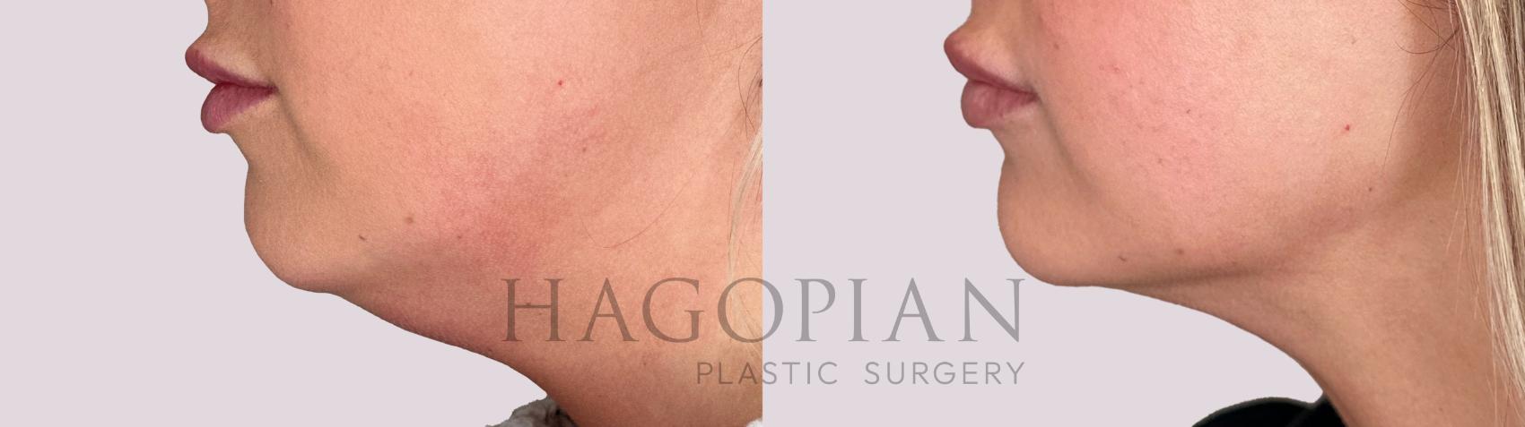 Before & After Chin Liposuction Case 167 Left Side View in Atlanta, GA