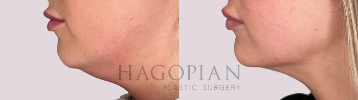 Before & After Chin Liposuction Case 167 Left Side View in Atlanta, GA