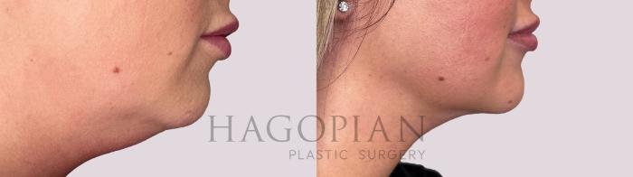 Before & After Chin Liposuction Case 167 Right Side View in Atlanta, GA