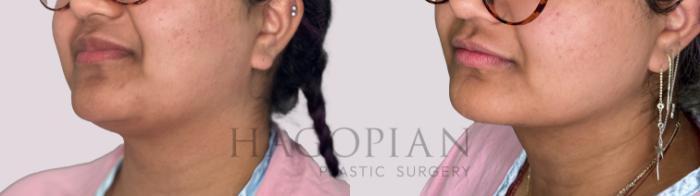 Before & After Chin Liposuction Case 174 Left Oblique View in Atlanta, GA