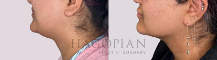 Before & After Chin Liposuction Case 174 Left Side View in Atlanta, GA