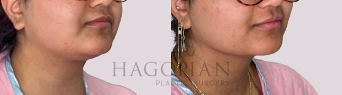 Before & After Chin Liposuction Case 174 Right Oblique View in Atlanta, GA