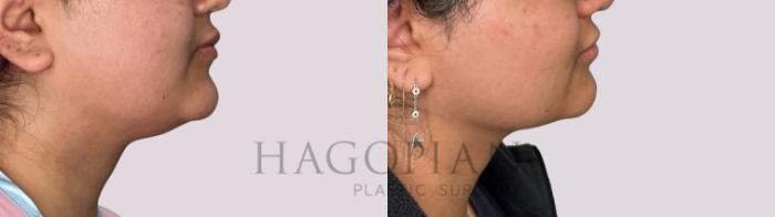 Before & After Chin Liposuction Case 174 Right Side View in Atlanta, GA