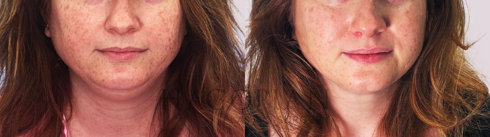 Before & After Chin Liposuction Case 179 Front View in Atlanta, GA