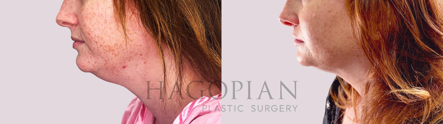 Before & After Chin Liposuction Case 179 Left Side View in Atlanta, GA