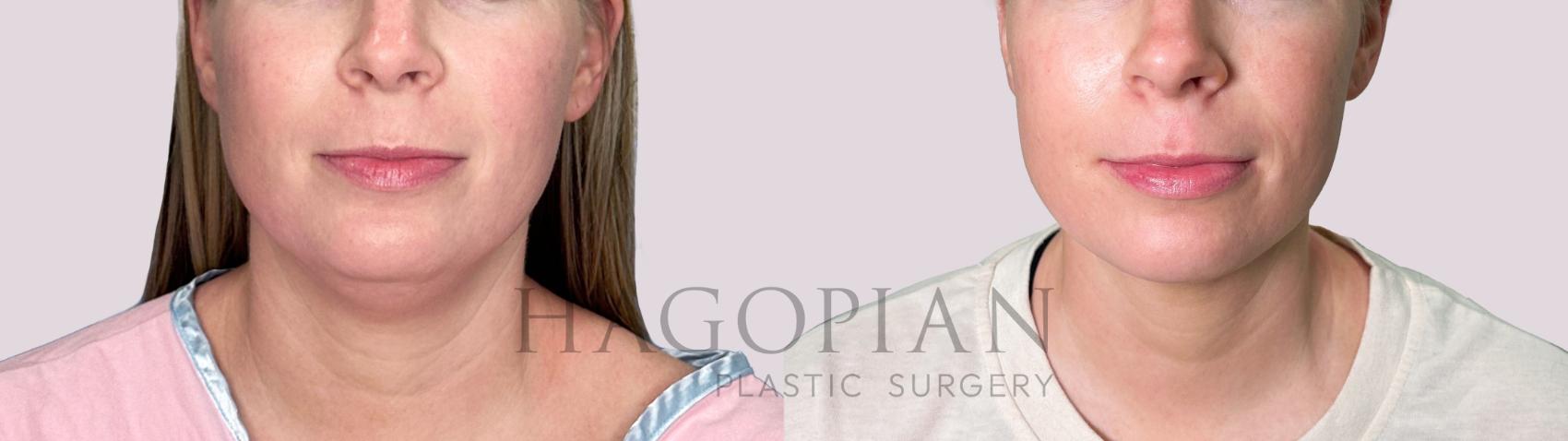 Before & After Chin Liposuction Case 183 Front View in Atlanta, GA