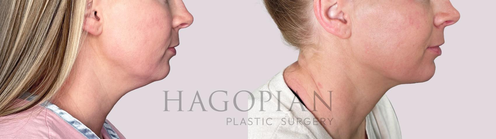 Before & After Chin Liposuction Case 183 Right Side View in Atlanta, GA