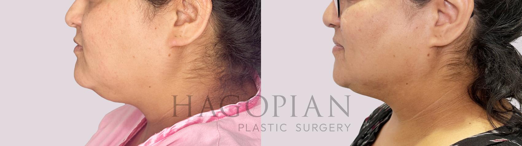 Before & After Chin Liposuction Case 186 Left Side View in Atlanta, GA