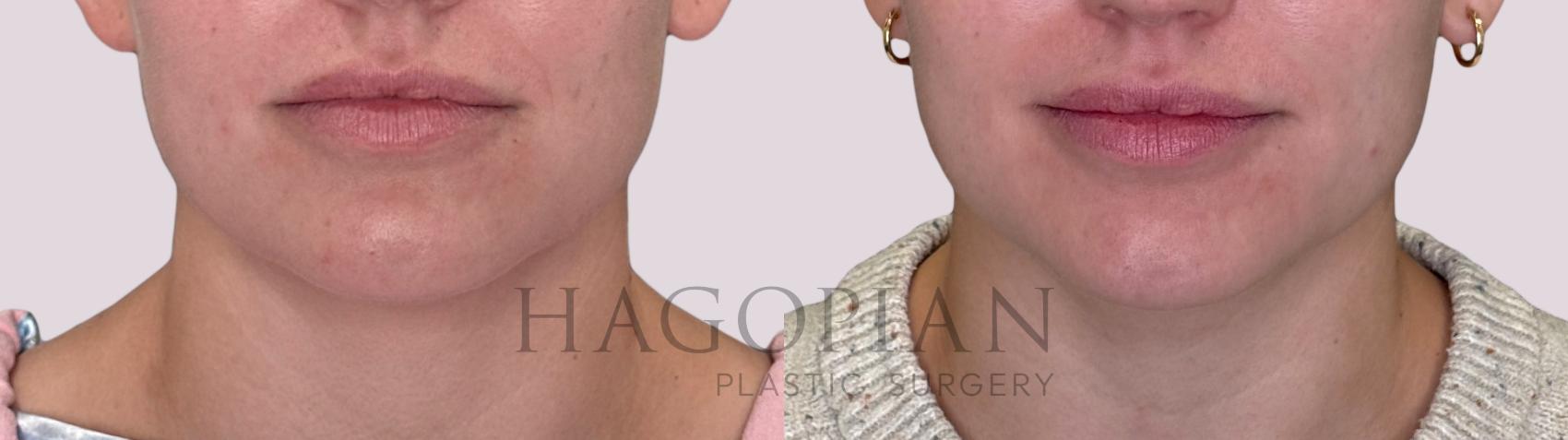 Before & After Chin Liposuction Case 214 Front View in Atlanta, GA