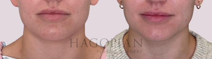 Before & After Chin Liposuction Case 214 Front View in Atlanta, GA