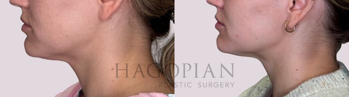 Before & After Chin Liposuction Case 214 Left Side View in Atlanta, GA