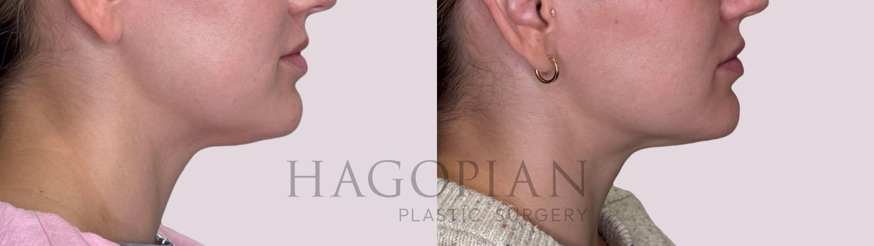 Before & After Chin Liposuction Case 214 Right Side View in Atlanta, GA