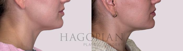 Before & After Chin Liposuction Case 214 Right Side View in Atlanta, GA
