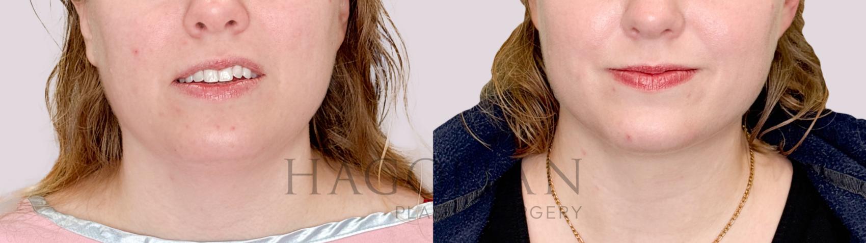Before & After Chin Liposuction Case 220 Front View in Atlanta, GA