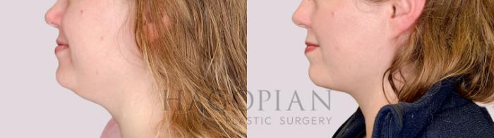 Before & After Chin Liposuction Case 220 Left Side View in Atlanta, GA