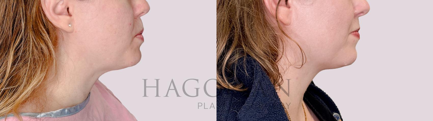 Before & After Chin Liposuction Case 220 Right Side View in Atlanta, GA