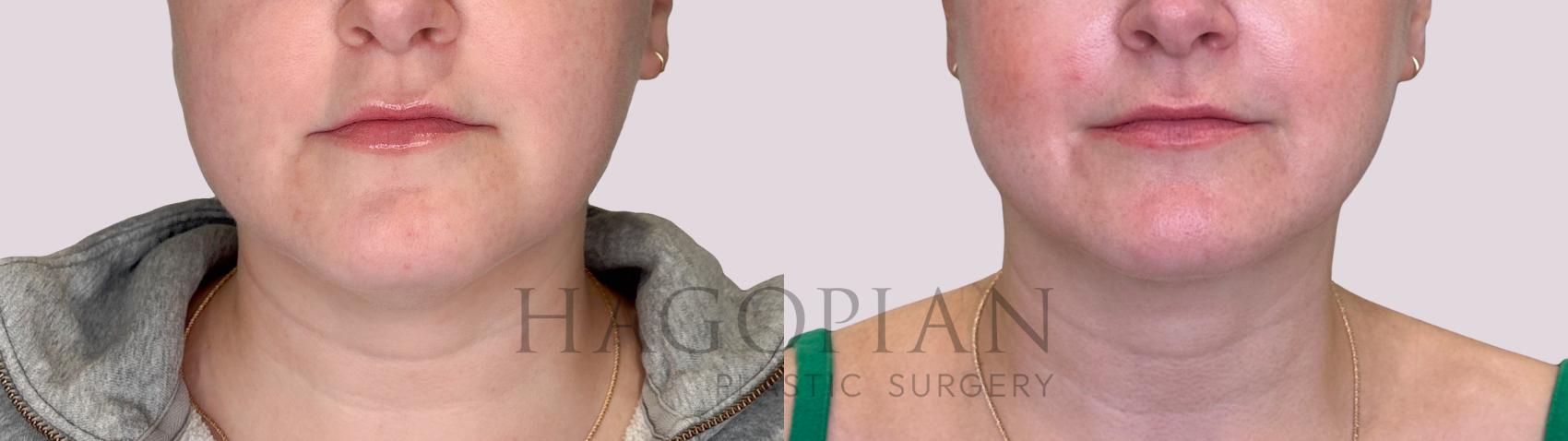 Before & After Chin Liposuction Case 238 Front View in Atlanta, GA