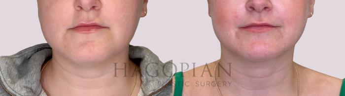 Before & After Chin Liposuction Case 238 Front View in Atlanta, GA