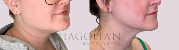 Before & After Chin Liposuction Case 238 Right Oblique View in Atlanta, GA