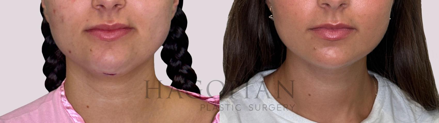 Before & After Chin Liposuction Case 242 Front View in Atlanta, GA