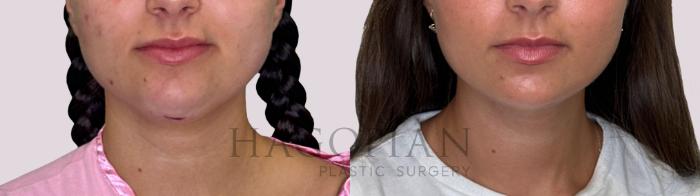 Before & After Chin Liposuction Case 242 Front View in Atlanta, GA