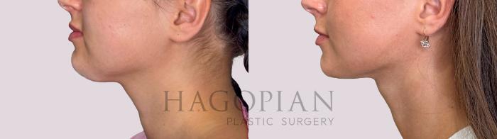 Before & After Chin Liposuction Case 242 Left Side View in Atlanta, GA
