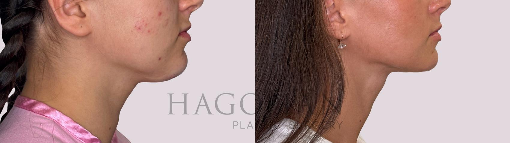 Before & After Chin Liposuction Case 242 Right Side View in Atlanta, GA