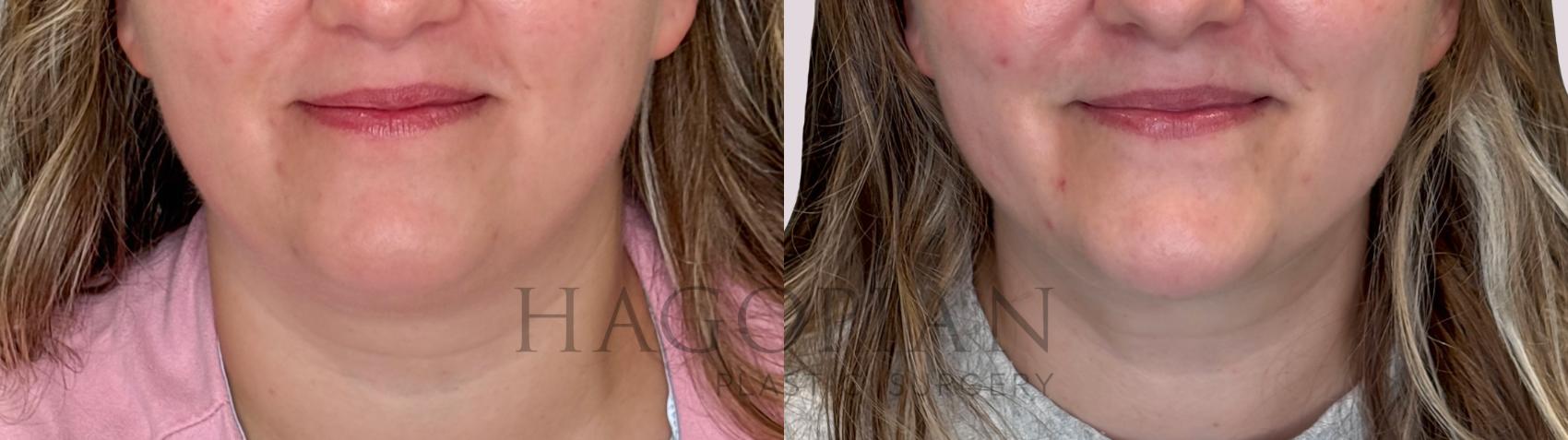 Before & After Chin Liposuction Case 248 Front View in Atlanta, GA