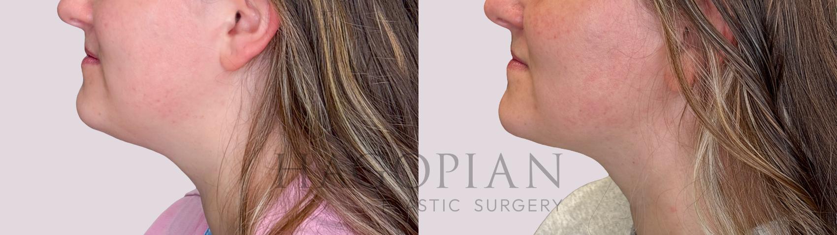 Before & After Chin Liposuction Case 248 Left Side View in Atlanta, GA