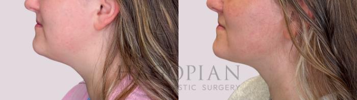 Before & After Chin Liposuction Case 248 Left Side View in Atlanta, GA