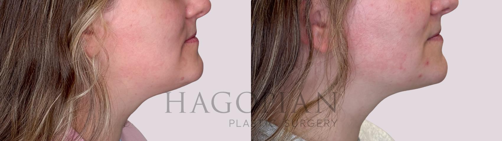 Before & After Chin Liposuction Case 248 Right Side View in Atlanta, GA