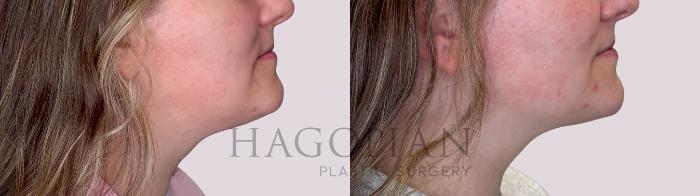 Before & After Chin Liposuction Case 248 Right Side View in Atlanta, GA