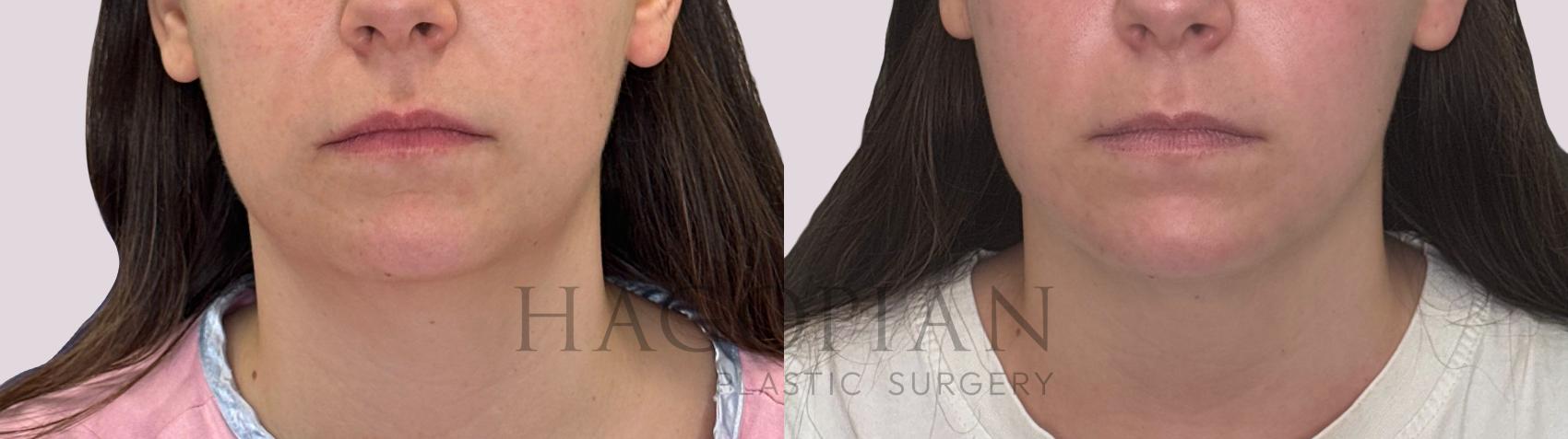 Before & After Chin Liposuction Case 280 Front View in Atlanta, GA