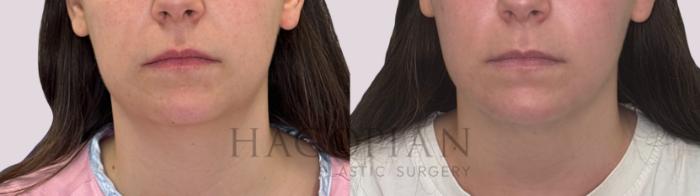 Before & After Chin Liposuction Case 280 Front View in Atlanta, GA