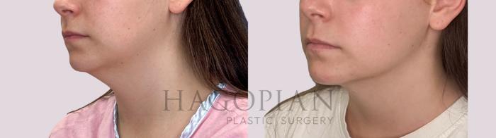 Before & After Chin Liposuction Case 280 Left Oblique View in Atlanta, GA